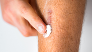 scar prevention and treatment at the Summit Skin Care