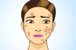 Antibiotics for acne -  are they in or out?
