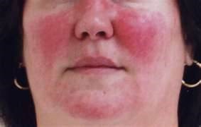 Getting the Red Out - Rosacea Treatments