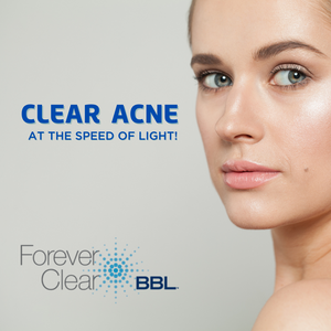 BBL Forever Clear Acne Treatments at The Summit