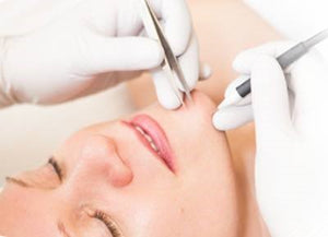 Electrolysis Treatments for Permanent Hair Removal at The Summit Spa in Halifax