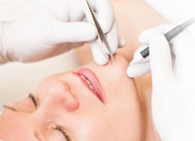 Electrolysis - Is Permanent Hair Removal for You?