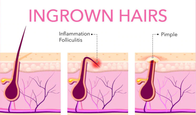 Top Tips for Preventing & Treating Ingrown Hairs