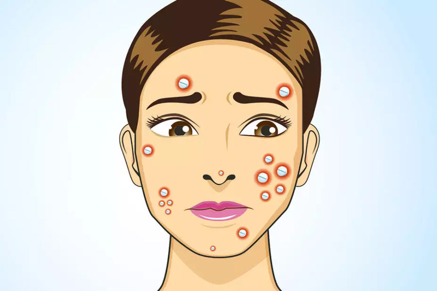 Antibiotics for Acne are they In or Out?